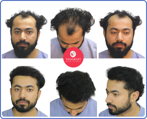 NeoDHT hair transplant before and after — NeoGraft Chandigarh