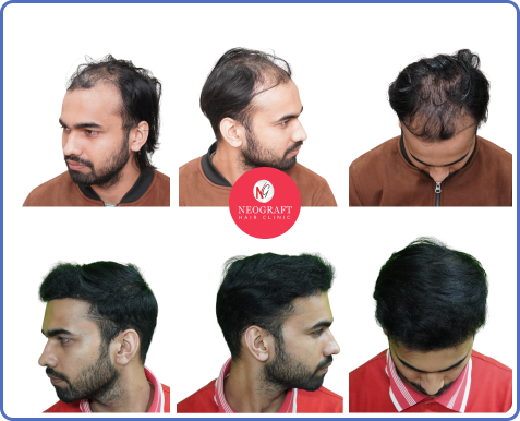 NeoDHT hair transplant before and after — NeoGraft Chandigarh