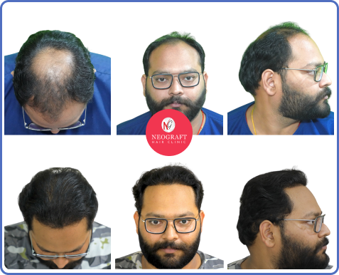 NeoDHT hair transplant before and after — NeoGraft Chandigarh
