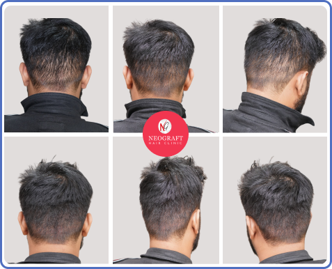 NeoDHT hair transplant before and after — NeoGraft Chandigarh