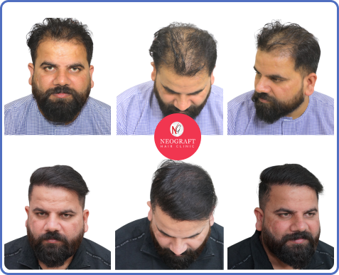 NeoDHT hair transplant before and after — NeoGraft Chandigarh