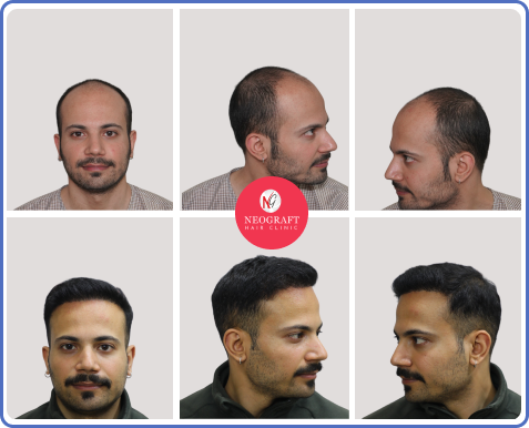 NeoDHT hair transplant before and after — NeoGraft Chandigarh