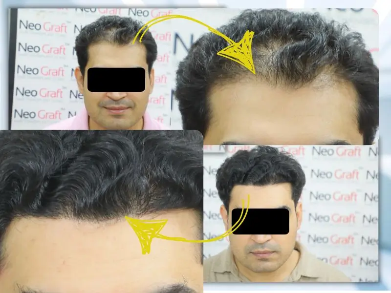 hairline