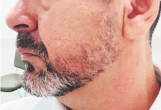 Beard hair transplant in Chandigarh at NeoGraft Hair Clinic