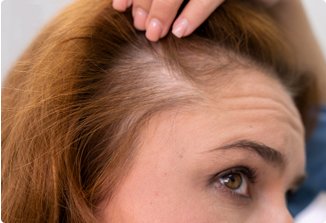 Female hair transplant in Chandigarh at NeoGraft Hair Clinic
