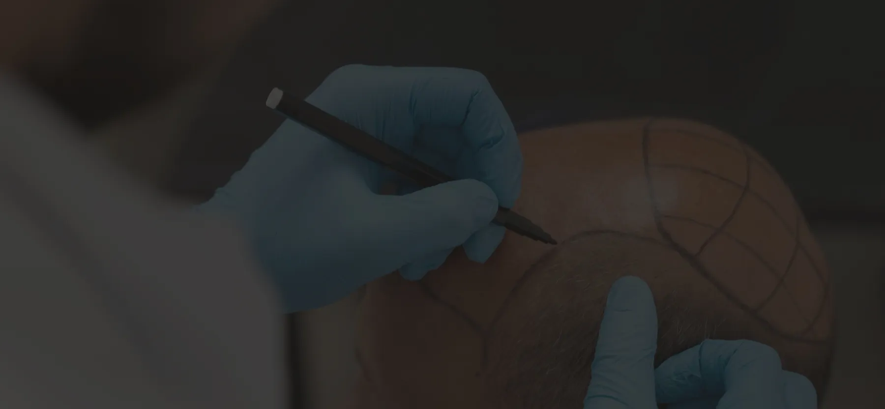 Banner image - NeoGraft Hair Clinic Chandigarh
