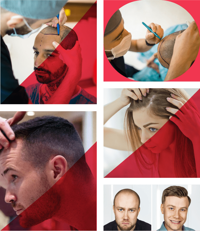 Frame 1032736 - NeoGraft Hair Clinic Chandigarh