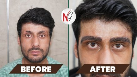 eyebrow-hair-transplant-before-after-1