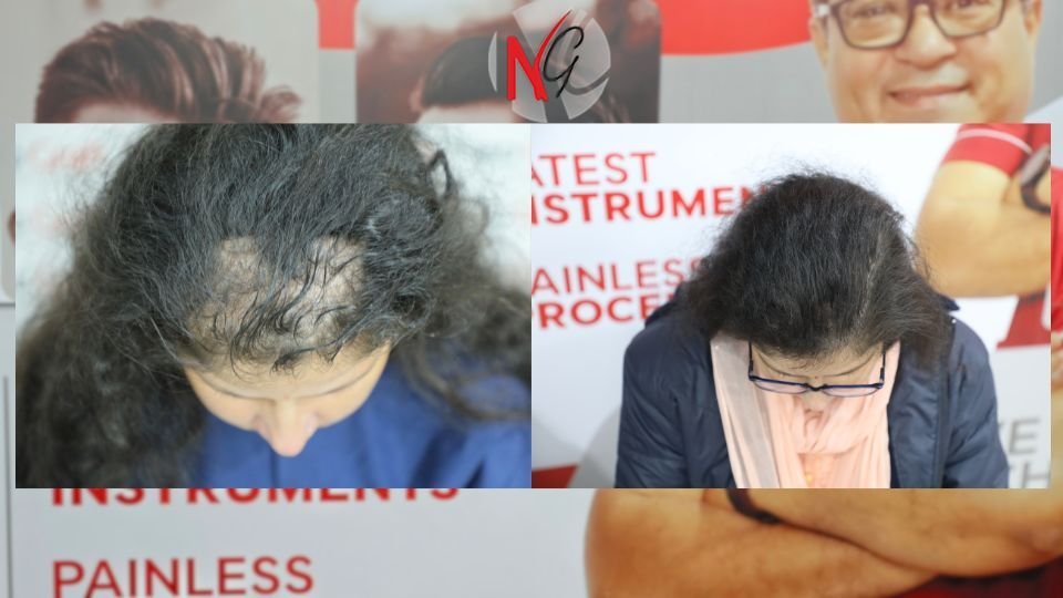 female hair transplant neograft chandigarh
