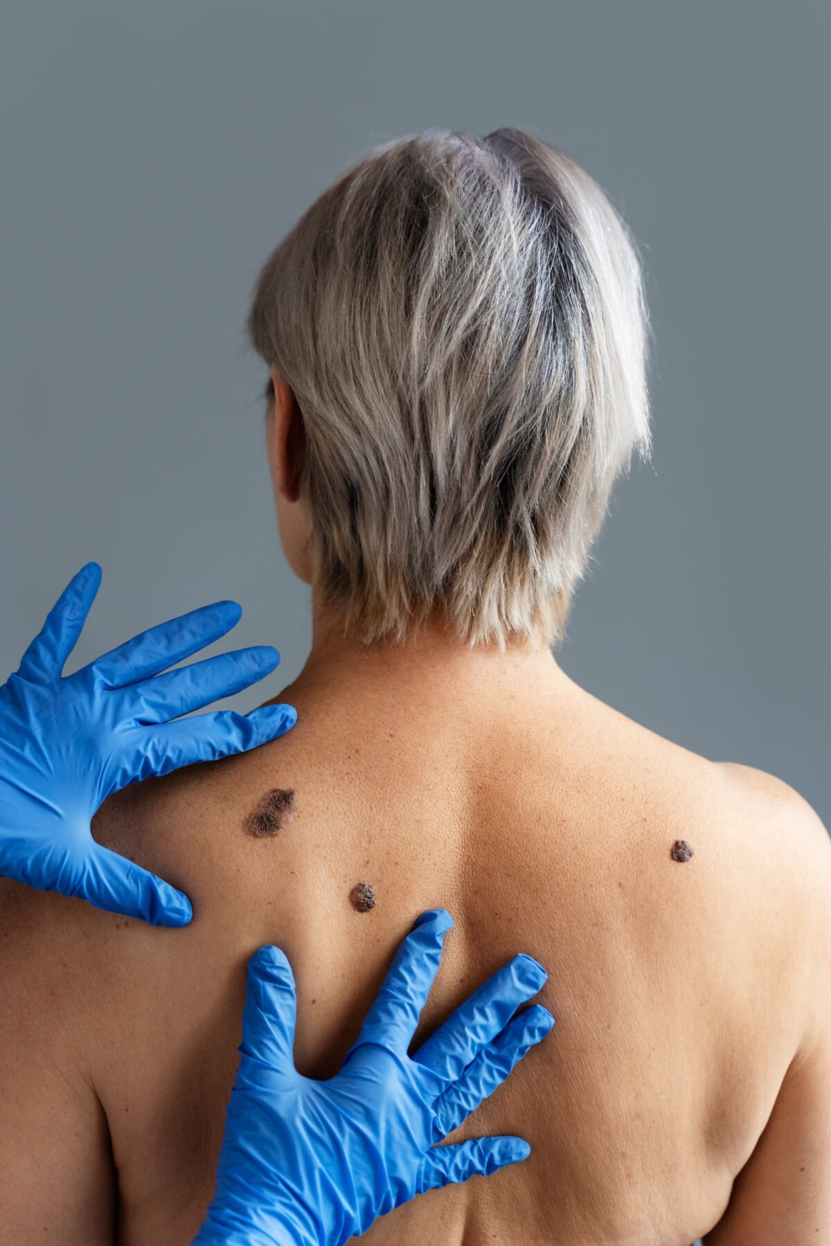 Sss scaled 1 - NeoGraft Hair Clinic Chandigarh